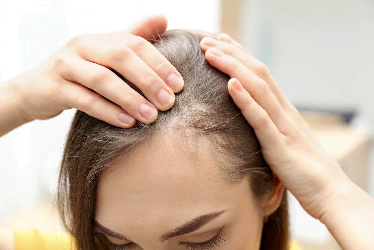 Сильно выпадают волосы на голове лечение. Истончение волос у женщин.