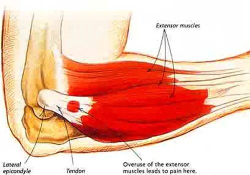 Сильная боль в локтевом. Эпикондилит локтевого сустава анатомия. Латеральный эпикондилит локтевого. Локоть теннисиста латеральный эпикондилит. Надмыщелок локтевого сустава.