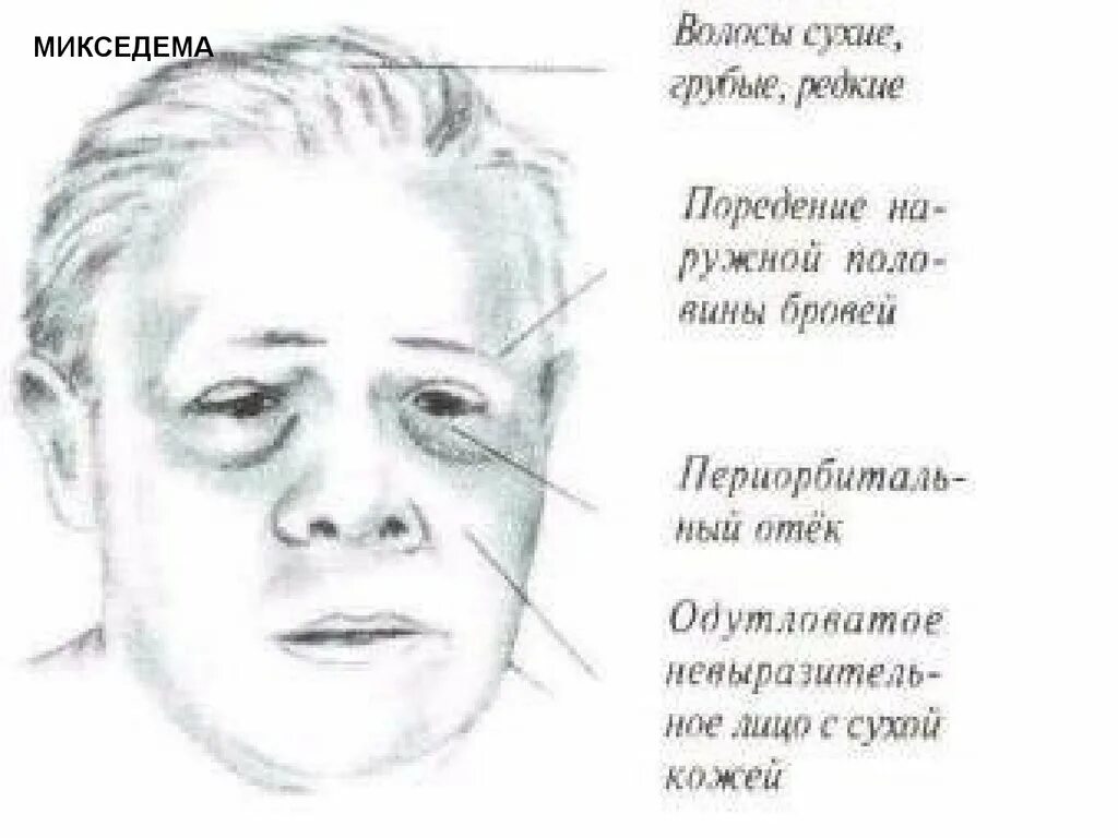Лицо после синус лифтинга. Одутловатость лица это. Одутловатость лица это. Одутловатость лица это. Одутловатость лица это.