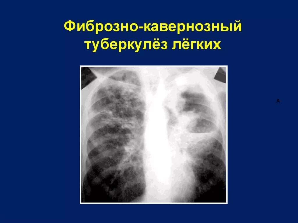 Старый туберкулез. Фиброзно-кавернозный туберкулез легких рентген. Фиброзно-кавернозный туберкулез легких синдромы. Каверна при туберкулезе на рентгене. Кавернозный туберкулез рентгенограмма.