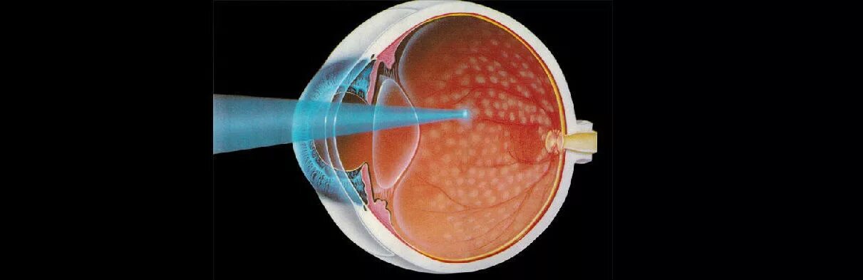 Периферическая лазеркоагуляция сетчатки. Периферическая лазеркоагуляция сетчатки ППЛК. Транспупиллярная лазеркоагуляция. Лазерная коагуляция после операции