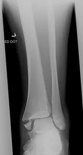 Open fracture