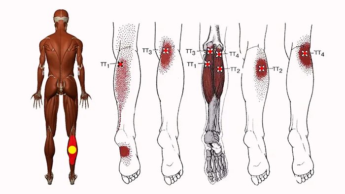 Тянет жила в ноге. Триггерные точки икроножной мышцы. Триггерные точки на ноге человека. Триггерные точки мышц голени. Триггерные точки стопы.