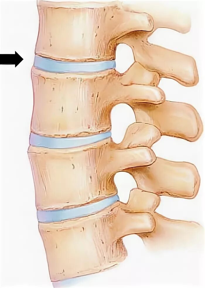 Остеохондроз поражение межпозвонковых дисков. Строение позвонка и межпозвоночного диска. Хрящевые диски между позвонками. Хрящи в позвоночнике. Межпозвонковый диск анатомия.