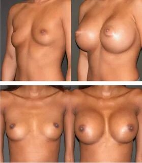 or breast implant surgery, is a procedure performed by a plastic surgeon to...