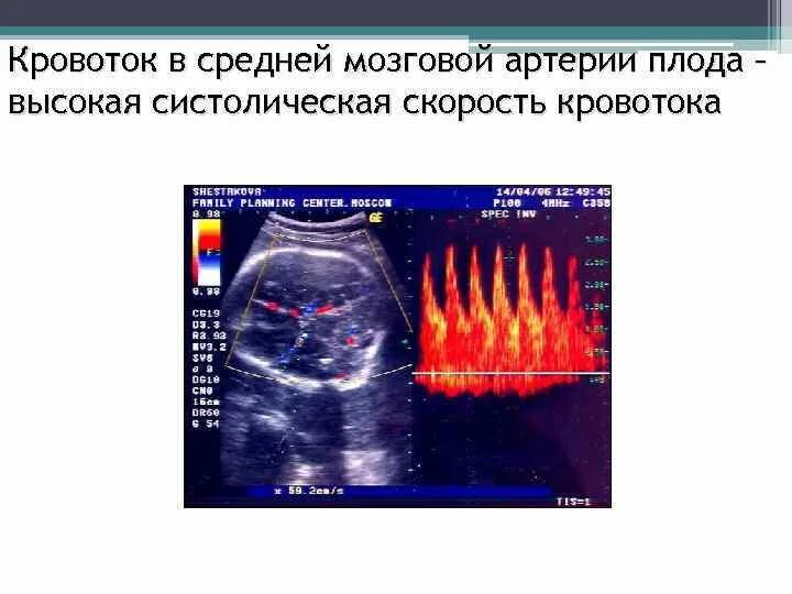 Сма плода. Скорость кровотока в средней мозговой артерии плода. Пиковая скорость кровотока в средней мозговой артерии плода. Допплерометрия кровотока средняя мозговая артерия нормы. Пиковая систолическая скорость кровотока в средней мозговой артерии.