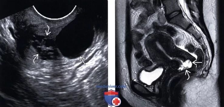 Наботовы кисты на УЗИ шейки матки.