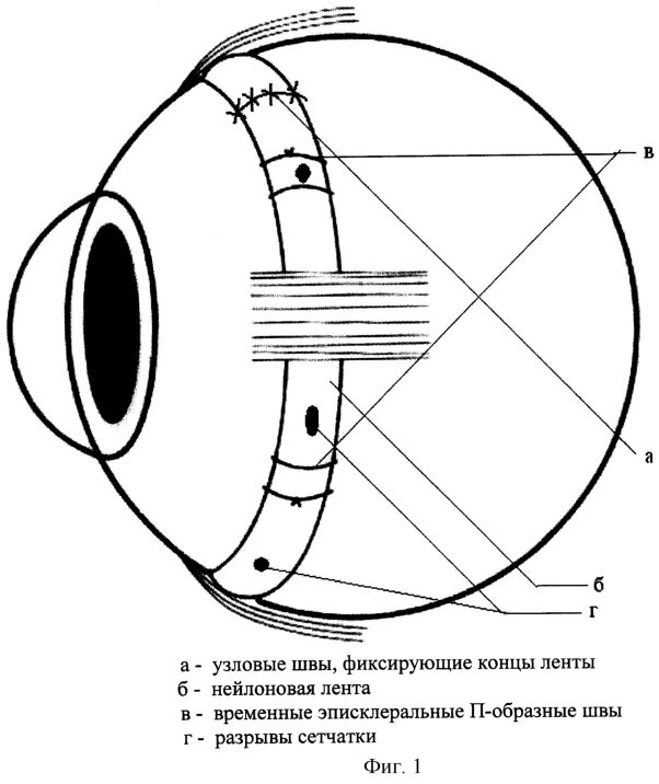 Пломбирование сетчатки. Локальное эписклеральное пломбирование сетчатки глаза. Экстрасклеральное пломбирование сетчатки глаза. Локальное эписклеральное пломбирование при отслойке сетчатки. Склеральное пломбирование сетчатки глаза.