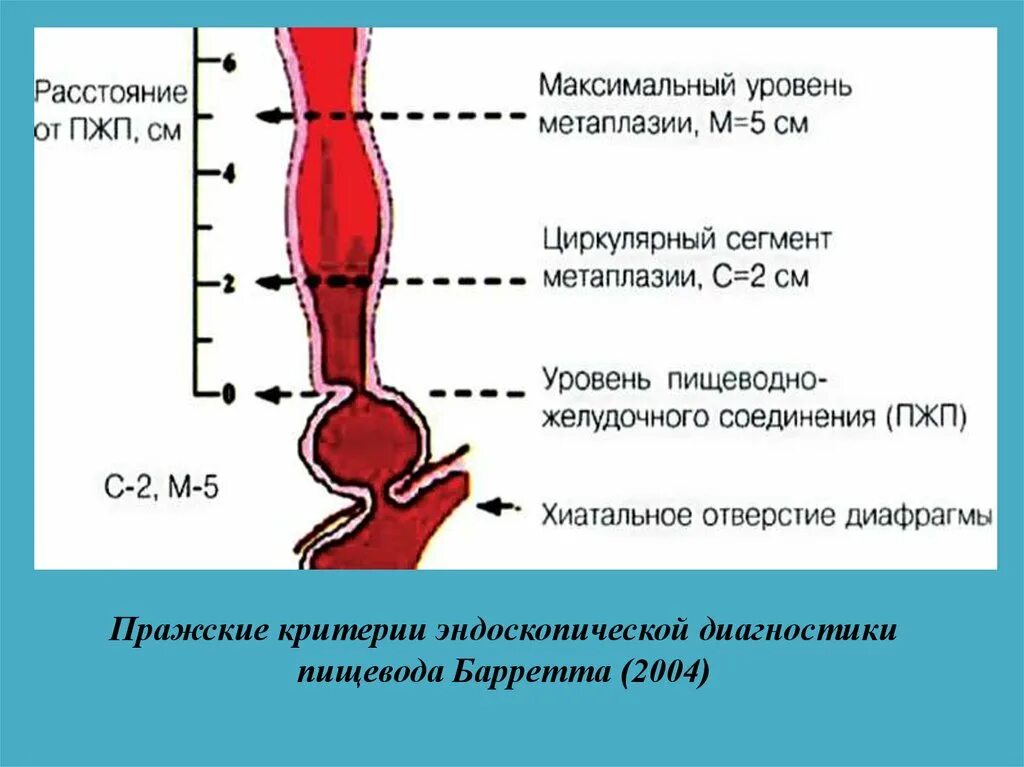 Пищевод баретта