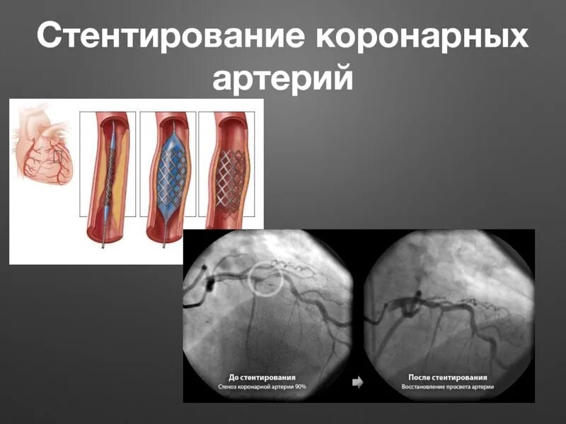 Стентирование сосудов жизнь после