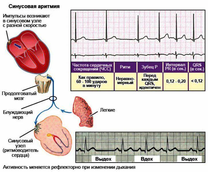 ЭКГ при нарушениях ритма сердца у детей. Нарушение синусового ритма сердца что это. Нормы по ЭКГ синусовая аритмия. Синусовая аритмия на ЭКГ У ребенка 10 лет.