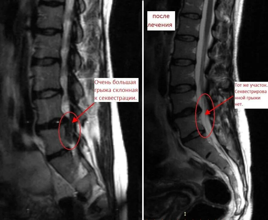 Секвестральная грыжа l5 s1. Секвестрированная грыжа l4-l5. Секвестрированная грыжа l5-s1 мрт. Секвестрированная грыжа межпозвонкового диска l4-l5. Удаления грыжи позвоночника поясничного отдела отзывы
