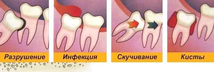 Лечение зуба 8. Перикоронарит воспаление. Катаральный перикоронарит. Перикоронарит симптомы.