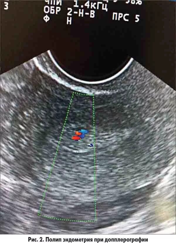 Полип эндометрия 6 мм на УЗИ. Гиперплазия эндометрия на УЗИ.