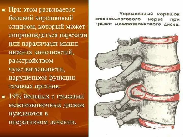 Торакалгия что это за диагноз лечение. Корешковый синдром позвоночника. Вертеброгенный корешковый синдром. Вертеброгенный болевой синдром. Корешковый болевой синдром.