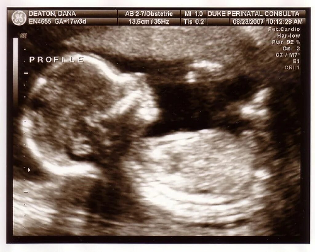 18 недель беременности размер плода. 17 недель фрукт. Эмбрион на 17 неделе развития ребенка. 17 недель беременности какой размер. 17 недель беременности какой размер.