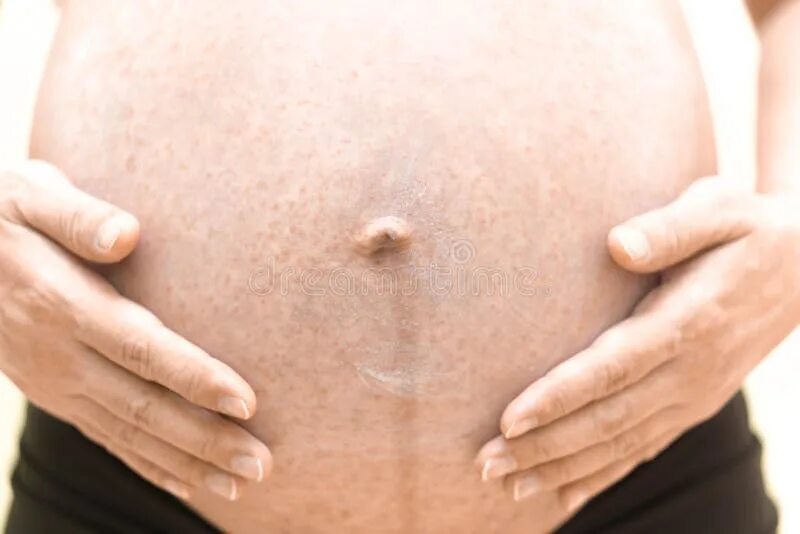 Аллергия на животе у беременной.