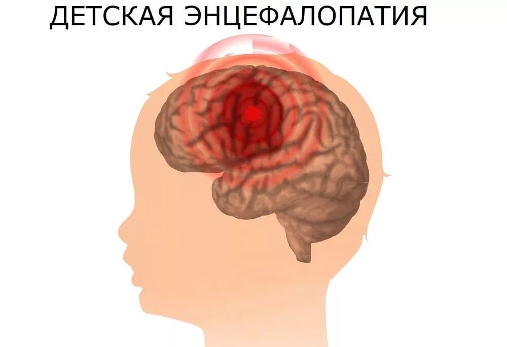 Черепно мозговая энцефалопатия. Энцелофапатия головного мозга у детей. Энцефалопатия головного мозга что это такое у ребенка. Травматическая энцефалопатия. Хтэ болезнь