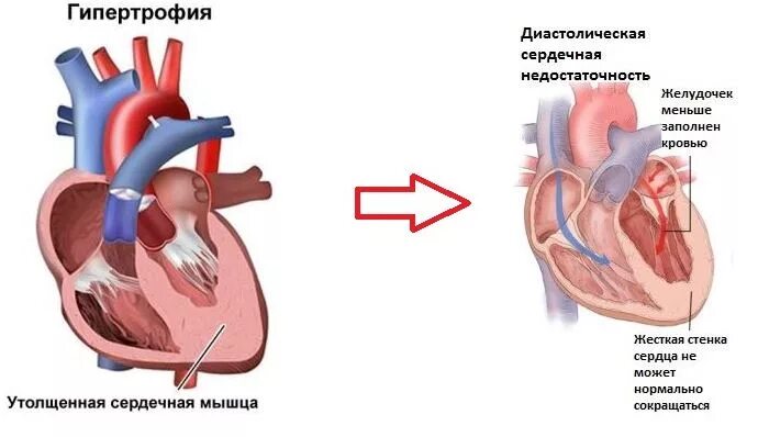 Сердце против часовой стрелки. Гипертрофия левого желудочка при ХСН. Диастолическая недостаточность левого желудочка. Гипертрофия папиллярных мышц левого желудочка сердца. Сердечная недостаточность при гипертрофии левого желудочка.