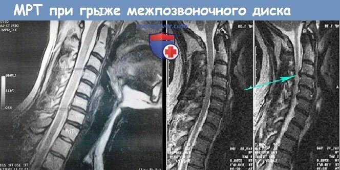 Диагноз код 42.1. Синдром шейной апертуры. М42.1 диагноз. Грыжа шейного отдела мкб 10. Код диагноза m42.1.