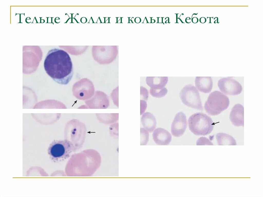 Тельце гейнца. Тельца Жолли и кольца Кебота. В эритроцитах кольца Кебота тельца Жолли. Включения в эритроцитах тельца Жолли. Тельца Жолли кольца Кебота анемия в12.