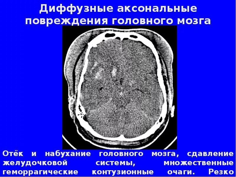 Диффузное аксональное повреждение. Диффузное аксональное повреждение головного мозга кт. диффузные аксональные повреждения кт. диффузные аксональные повреждения головного мозга мрт. аксональное повреждение головного мозга мрт.