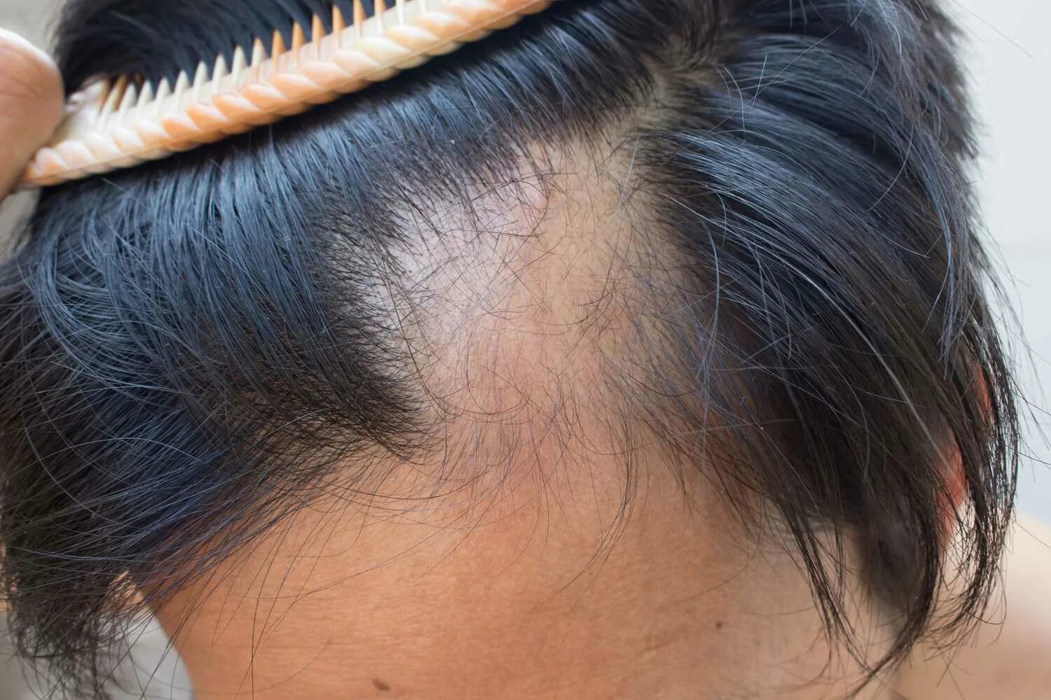 Очаговая алопеция (alopecia Areata). Гнёздная (очаговая алопеция).