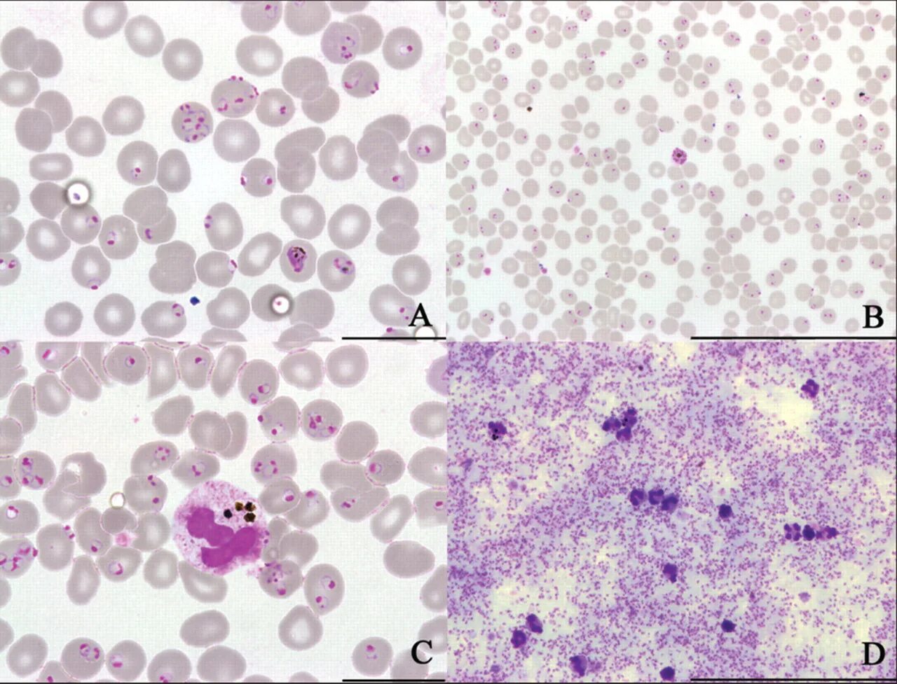 Малярия фальципарум. Плазмодиум фальципарум. Плазмодиум микробиология. Тяжелое течение малярии ассоциируется чаще