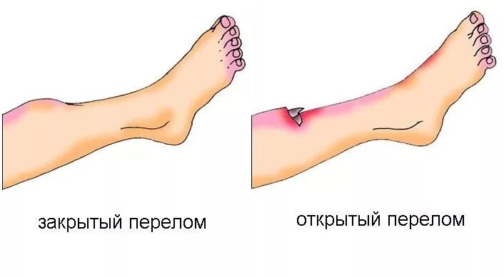 признаков определяют открытый перелом конечностей