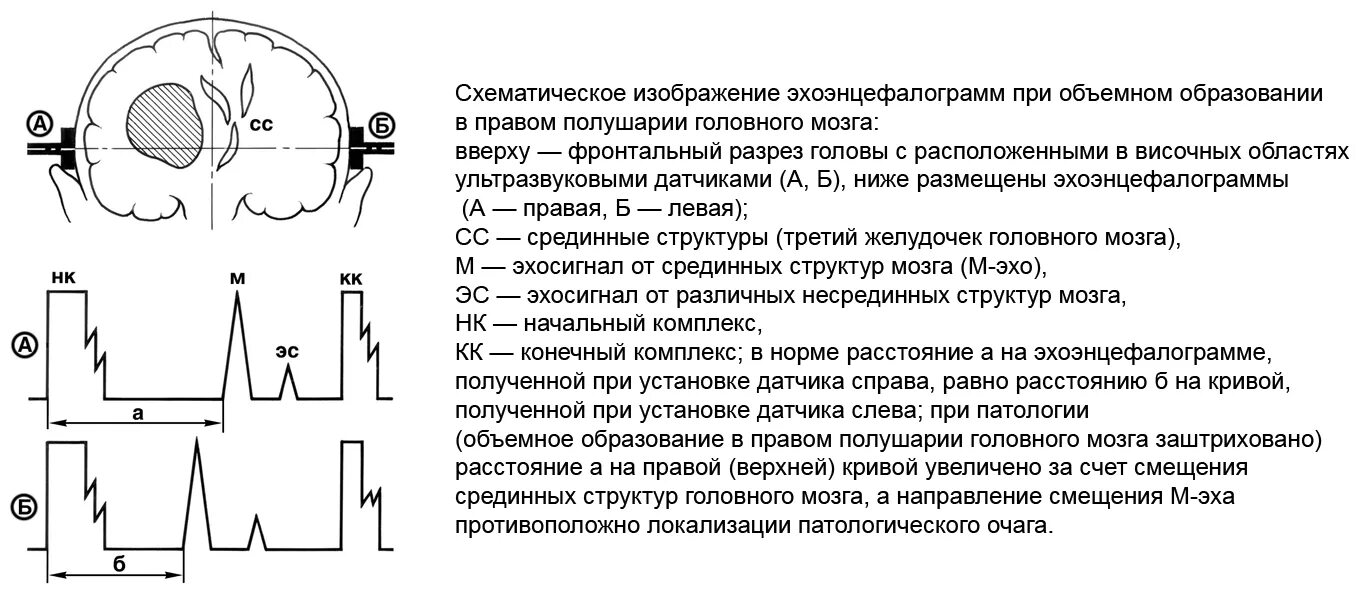 Эг ээг. Эхоэнцефалограмма головы расшифровка. Эхоэнцефалоскопия головного мозга норма. Эхо ЭГ расшифровка результатов. Эхо головы норма показателей.