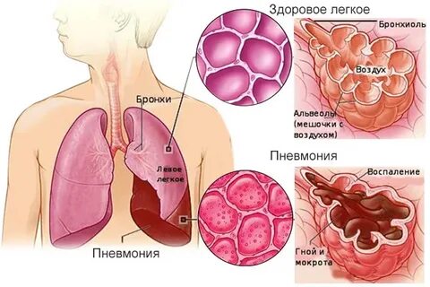 Пневмония симптомы как распознать