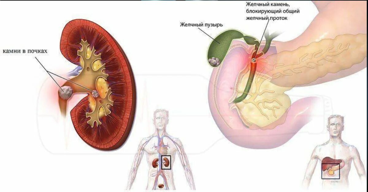 Мочекаменная и желчекаменная болезни. Желчнокаменная и мочекаменная болезни. Желчные и почечные камни. Камни в почках и желчном пузыре.