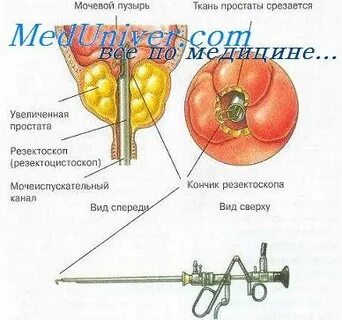 Удаление мочевого пузыря сколько длится операция