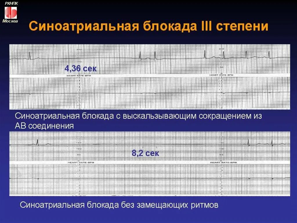 ЭКГ синоатриальной блокады 3 степени. ЭКГ при синоатриальной блокаде 3 степени. Признаки синоатриальной блокады 3 степени. Синоатриальная блокада первой степени. Са блокада степени