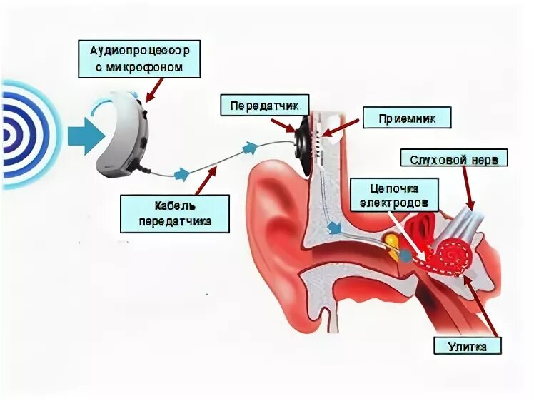 Кохлеарный имплантат принцип действия. Операция по установке кохлеарного имплантата.