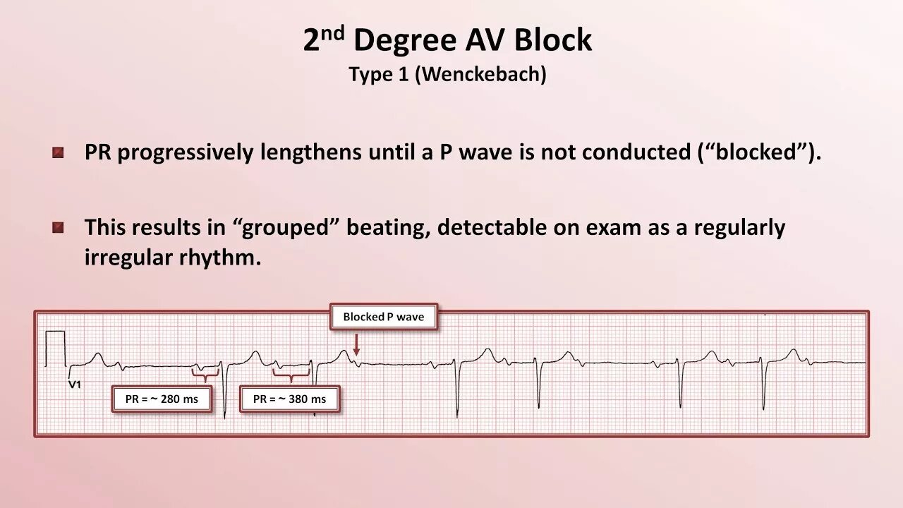 3rd degree av Block ECG. Av Block III ECG. Av Blocks 3 degree ECG. EKG complete av Block. Av block remover сайт