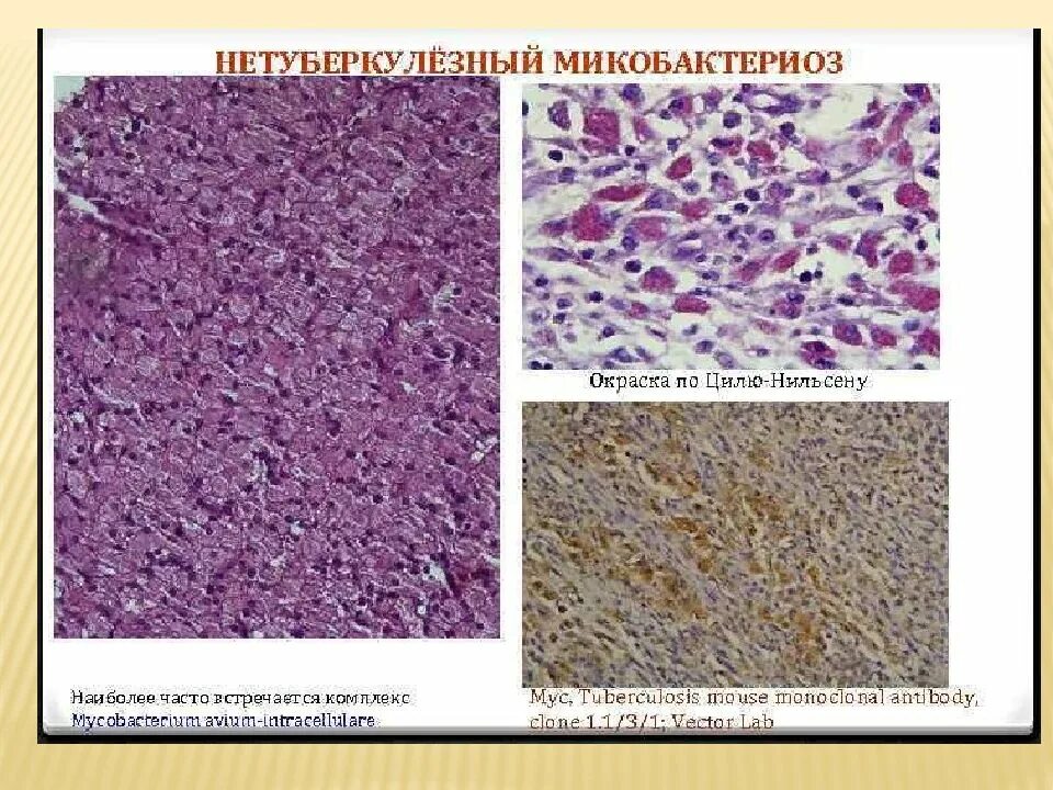 Нетуберкулезный микобактериоз. Циль Нильсен гистология. Микобактериоз гистология. Нетуберкулезные микобактерии атипичные.