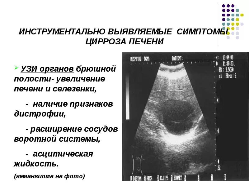 Портальная гипертензия на узи. Узи картина цирроза печени крупноузловой. Узи признаки цирроза. Узи критерии портальной гипертензии. Узи признаки цирроза.