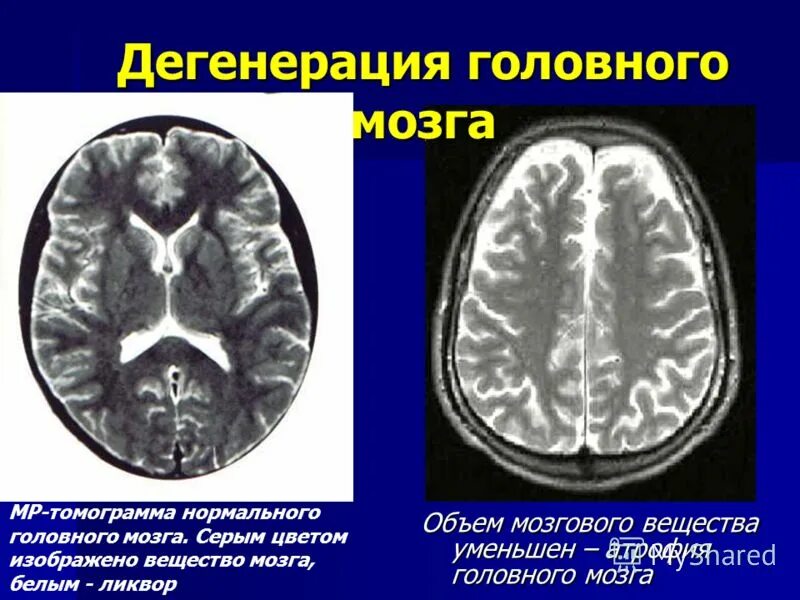 Дегенерация головного мозга. Атрофические процессы головного мозга. Порэнцефалия головного мозга. Атрофия вещества головного мозга на кт. Диффузное поражение головного