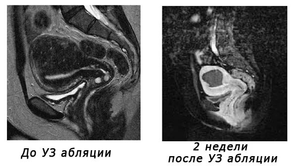 Фуз-абляция миомы матки. Мрт эндометрия