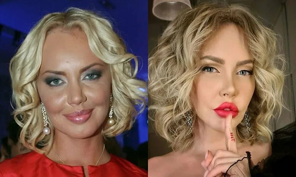 Неудачный ботокс губ до и после 59 фото