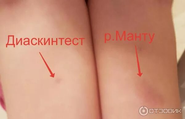 Диаскинтест что это. Реакция манту диаскинтест норма.