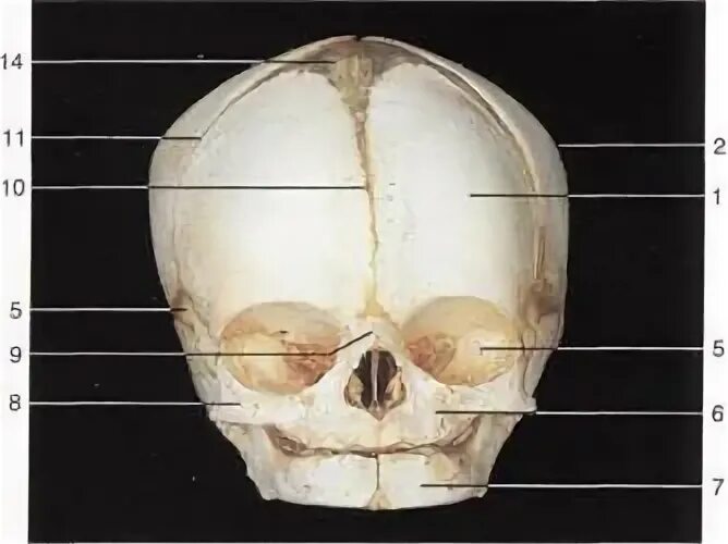 Деформация кости черепа. Анатомия лобной кости черепа. Теменная кость черепа трещина. Надблоковое отверстие лобной кости. Шов на лобной части черепа.