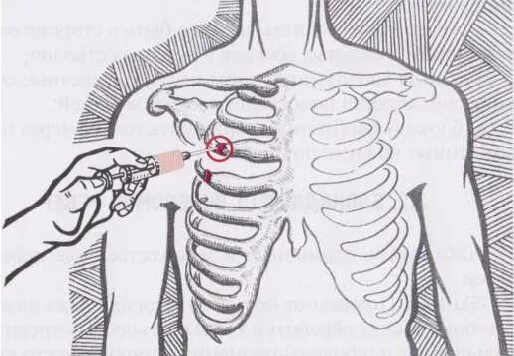Межреберная блокада. Новокаиновая блокада ребер. Межреберная новокаиновая блокада техника. Межреберная паравертебральная блокада. Новокаиновая блокада при переломе ребер.