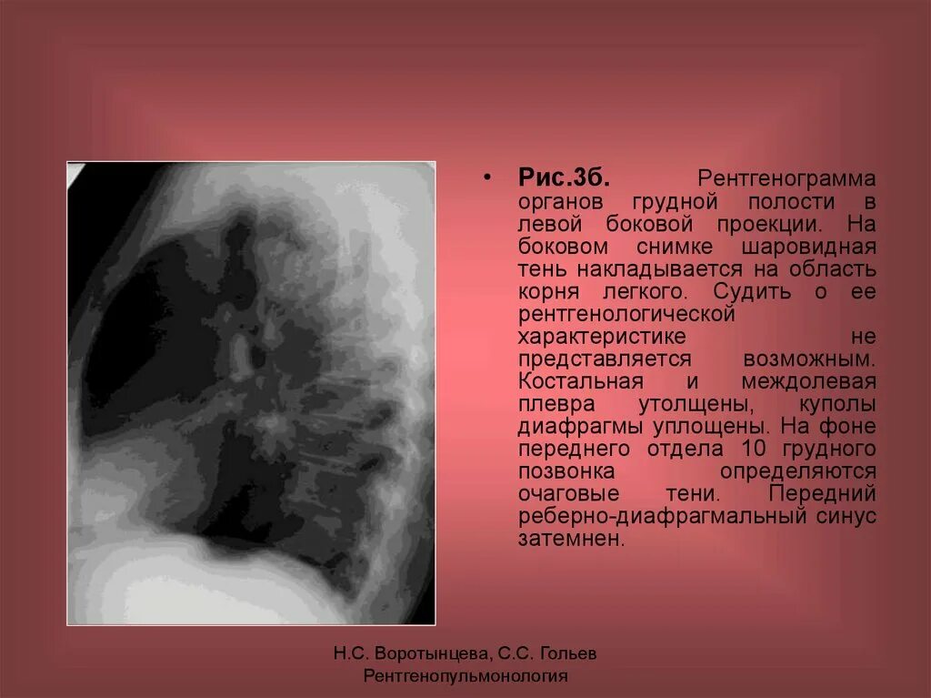 Заболевания органов грудной полости. Качество рентгенограммы. Заболевания органов грудной полости. Плевральные синусы на рентгене. Повреждение грудной клетки и органов грудной полости.