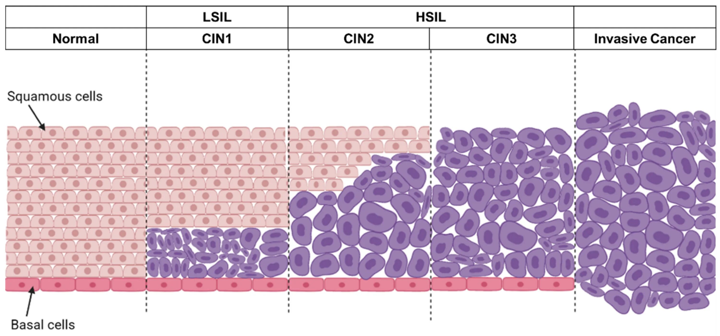 Lsil интраэпителиальное поражение низкой. Дисплазия шейки матки Cin 1.