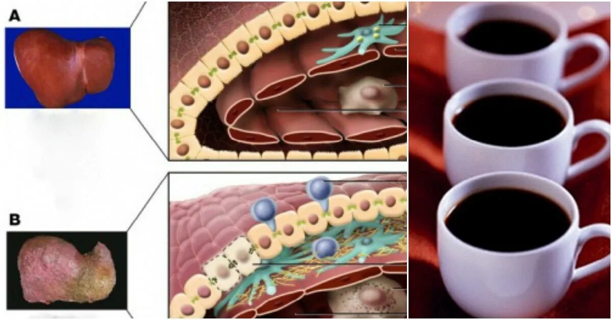 Кофе и печень как влияет. Влияние кофе на печень. Кофе влияет на печень. Печень от кофе. Кофе вредит печени.