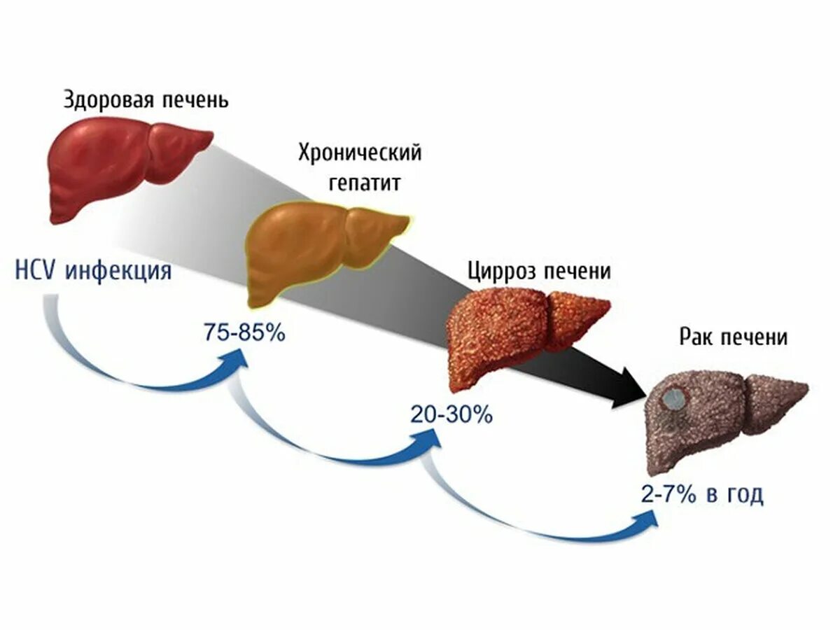 Степени фиброза печени.