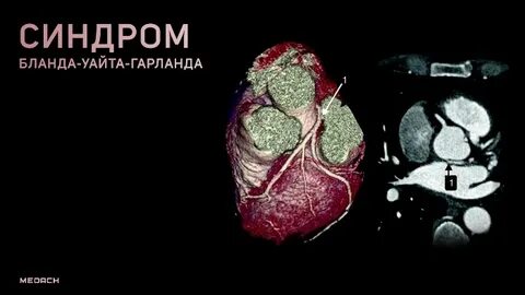 Синдром бланда уайта