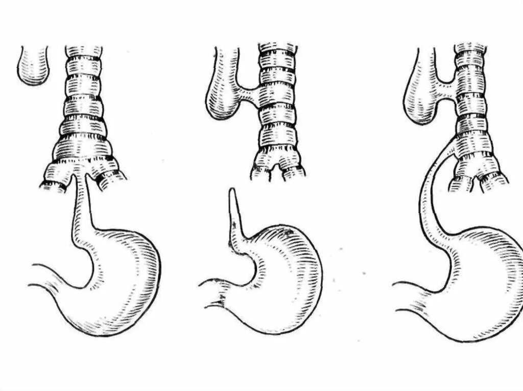 Формирование пищевода. Пишеводнно бронхияльный свишь. Врожденный пищеводно-трахеальный свищ это. Бронхопищеводные свищи. Пищеводно-бронхиальные свищи.